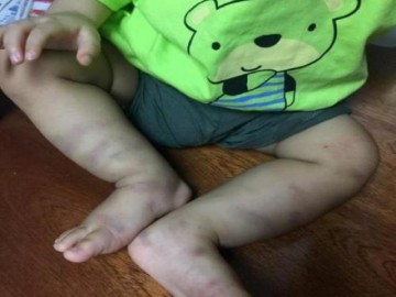 Bé trai 14 tháng tuổi bị bạo hành dã man ở Hà Nội đã rơi vào tình trạng hôn mê sâu