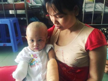 Bé gái 2 tuổi bỗng hóa “Sọ dừa” vì căn bệnh hiếm gặp