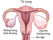 Sức khỏe - 6 dấu hiệu cảnh báo bệnh ung thư buồng trứng, chị em cần lưu ý