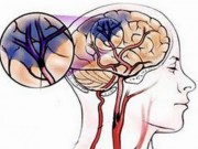 Sức khỏe - Làm sao biết bị thiếu máu não?