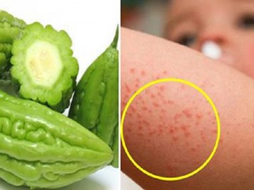 Điều trị rôm sảy bằng phương pháp dân gian