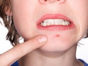 Làm đẹp - Trị mụn bọc hiệu quả bằng những nguyên liệu thiên nhiên xung quanh bạn