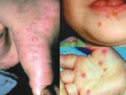 Sức khỏe - Con gặp nguy hiểm vì cha mẹ nhầm bệnh chân tay miệng với dị ứng da