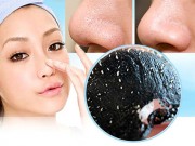 Làm đẹp - Đi tìm phương pháp trị mụn đầu đen hiệu quả nhất mà không làm tổn hại làn da