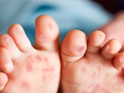 Sức khỏe - Nuốt đau, chảy nước dãi là dấu hiệu sớm của bệnh tay chân miệng