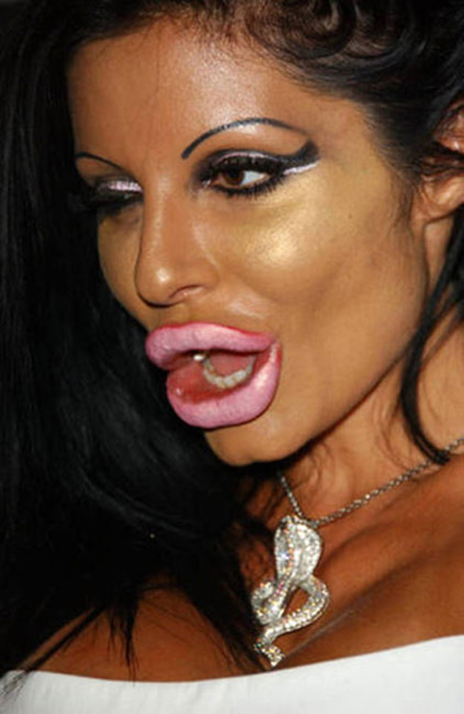 Với mong muốn được giống như Angelia Jolie, cô gái này đã biến đôi môi của mình thành 'chiếc bánh' căng phồng đáng sợ. 
