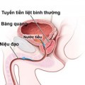 Sức khỏe - Bệnh của tiền liệt tuyến