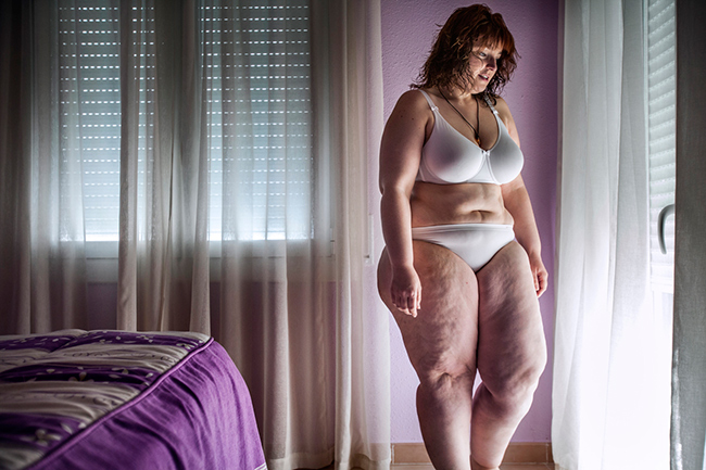Sandra, 31 tuổi, người Tây Ban Nha, bị bệnh béo phì với vòng hai quá khổ và cặp đùi núng nính mỡ.
