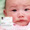 Làm mẹ - Cảnh báo con hoại tử vì thuốc viêm da