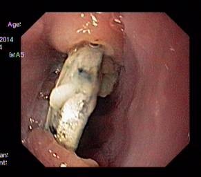 Cục pin hoen gỉ trong thực quản bé trai 2 tuổi - 1