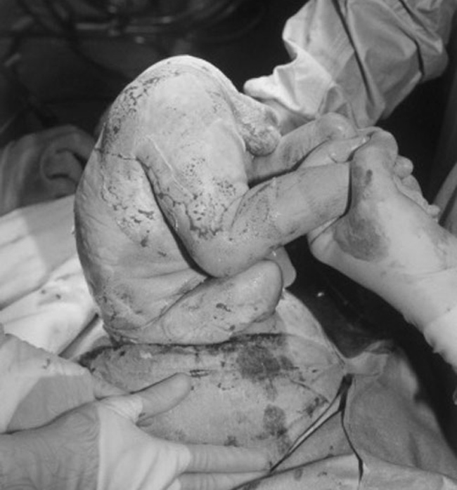 Những em bé ngược ngôi thai cũng thường được chỉ định đẻ mổ.
