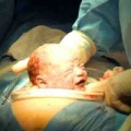 Bà bầu - "Xem tận mắt" từng bước một ca sinh mổ