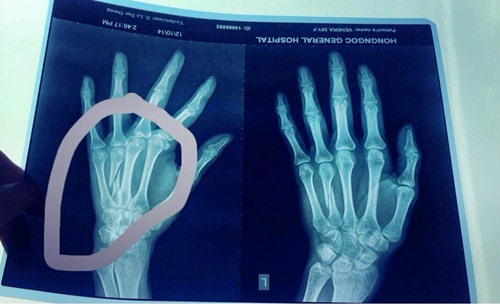 Hoàng Yến lên tiếng việc làm gãy tay mẫu Tây - 4