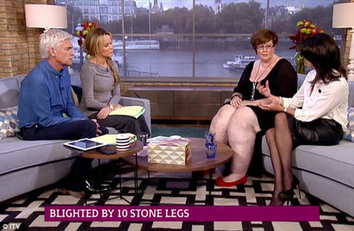 Gặp người phụ nữ sở hữu đôi #039;chân voi#039; nặng 63kg - 4