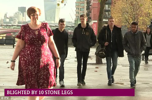 Gặp người phụ nữ sở hữu đôi #039;chân voi#039; nặng 63kg - 3