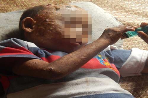 Cảm thương bé 7 tuổi mắc bệnh lạ phồng rộp toàn thân - 1