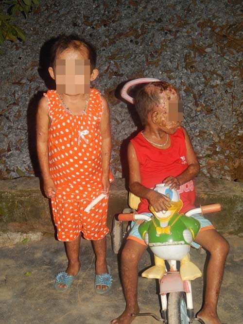 Cảm thương bé 7 tuổi mắc bệnh lạ phồng rộp toàn thân - 2