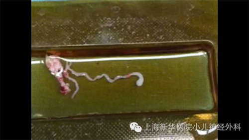 Sán dài 8cm làm tổ trong não bé trai 11 tuổi - 1