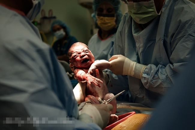 Hình ảnh em bé chào đời từ một ca sinh mổ.
