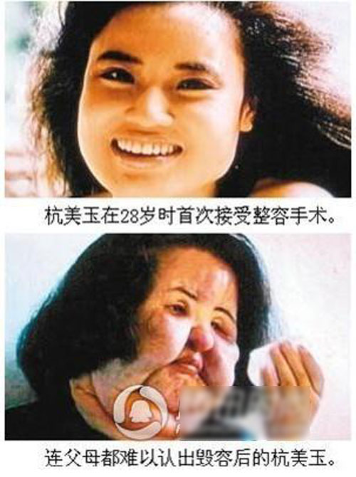 Hậu quả khôn lường vì quot;cuồngquot; phẫu thuật thẩm mỹ - 6