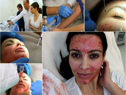 Bủn rủn với mốt trẻ hóa, căng da mặt bằng... máu - 3