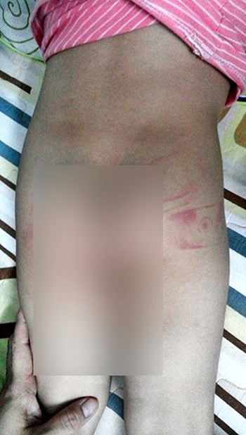 Bé 3 tuổi bị cô giáo đánh tím người vì liên tục vào nhà vệ sinh - 2