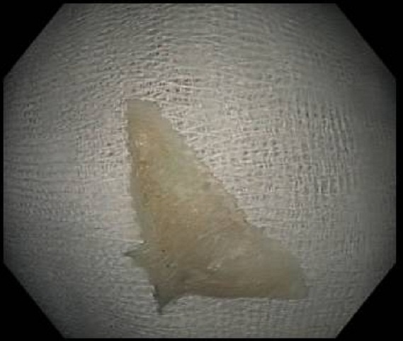 Bị thủng thực quản vì nuốt phải xương cá - 2