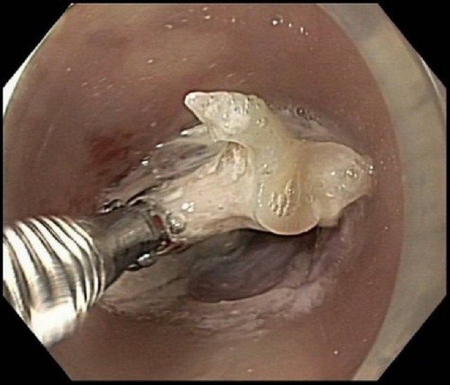 Bị thủng thực quản vì nuốt phải xương cá - 1