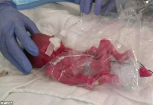 Chuyện lạ: Mẹ mang thai đôi bỗng sinh non một bé - 1