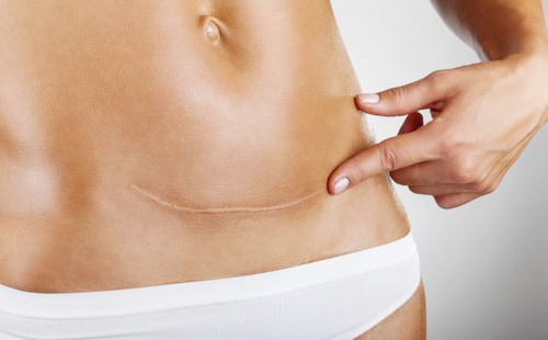 Những nguy hiểm quot;rình rậpquot; mẹ sau sinh mổ - 3