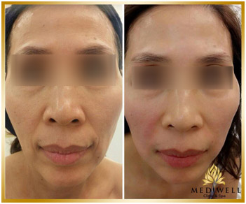 “Mua” 10 năm tuổi trẻ? Khó tin nhưng có thật! - 2
