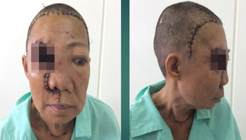 Chuyện người đàn bà ‘mọc thêm đầu’ trên mặt - 2