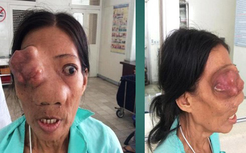 Chuyện người đàn bà ‘mọc thêm đầu’ trên mặt - 3