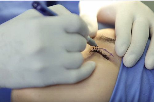 Phải làm sao khi mí mắt không đều? - 4