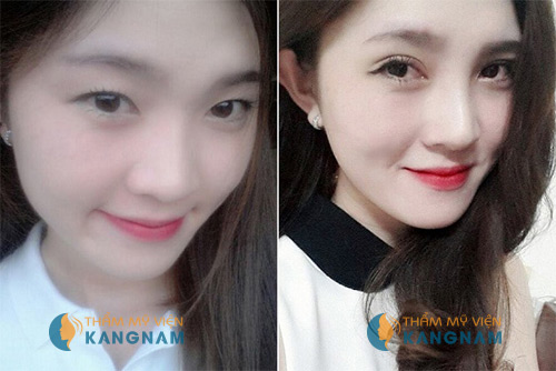 Phải làm sao khi mí mắt không đều? - 5