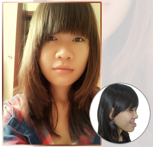 Phẫu thuật hàm hô móm: Thay đổi cuộc đời - 1