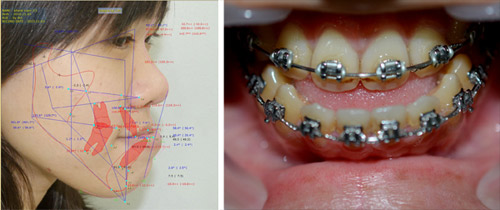 Phẫu thuật hàm hô móm: Thay đổi cuộc đời - 3