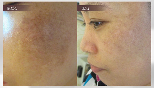 Kinh nghiệm trị nám lâu năm khỏi trong “chốc chát” - 2