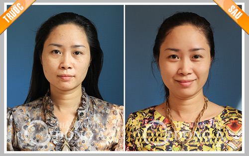 Kinh nghiệm trị nám lâu năm khỏi trong “chốc chát” - 5