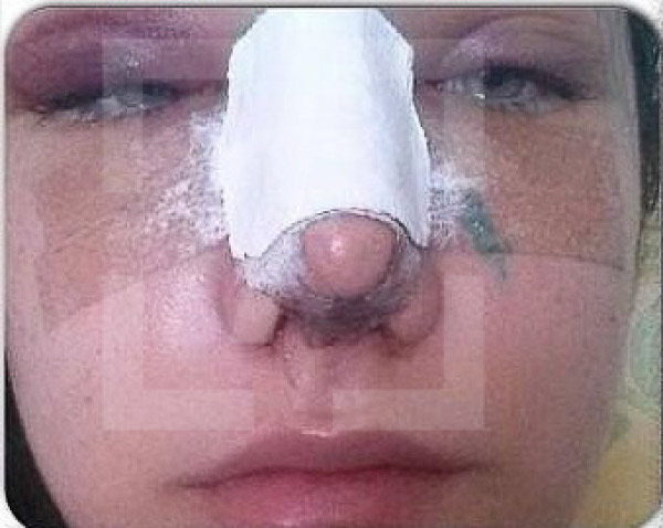 Tân Hoa hậu quốc tế 2015 bị rò rỉ ảnh phẫu thuật thẩm mỹ - 3