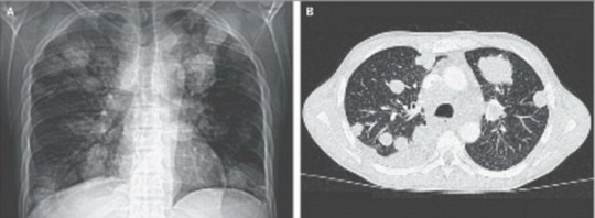 “Sốc” với phát hiện ung thư có thể lây qua sán dây - 1