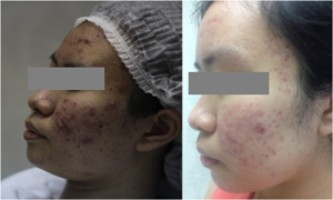 Phương pháp mới ‘thổi bay’ mụn trứng cá đáng ghét - 3