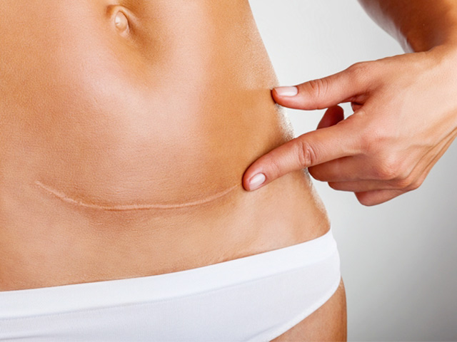 Chăm sóc vết mổ đẻ đúng cách sau sinh - 1