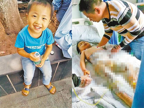 Mẹ lơ là con 4 tuổi ngã vào nồi sữa nóng - 1