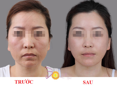 Khuyến mại 75% công nghệ căng da, xóa nhăn Ultherapy - 2