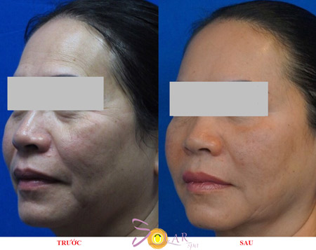 Khuyến mại 75% công nghệ căng da, xóa nhăn Ultherapy - 3