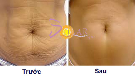 Khuyến mại 75% công nghệ căng da, xóa nhăn Ultherapy - 4
