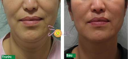 Khuyến mại 75% công nghệ căng da, xóa nhăn Ultherapy - 5
