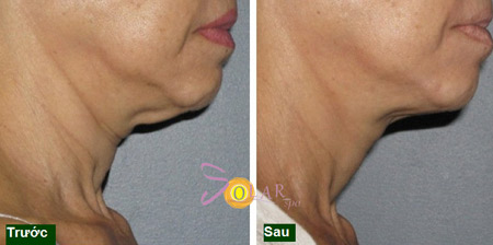 Khuyến mại 75% công nghệ căng da, xóa nhăn Ultherapy - 6