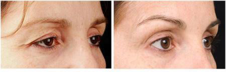 Mí mắt sụp do lão hóa, phải làm sao? - 2